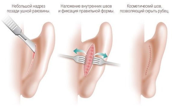 корреция лопоухости в Москве