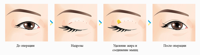 Блефаропластика азиатских глаз (Сингапури)