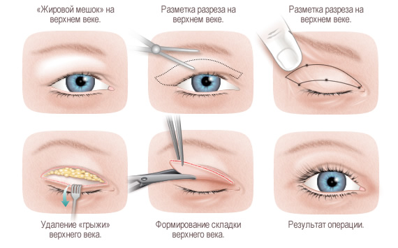 блефаропластика-верхних-век
