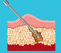 dry-lipo