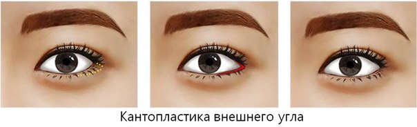 капнопластика-внешнего-уголка-глаз