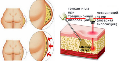 лазерная-липосакция-ягодиц