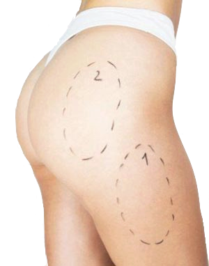 lipobeder