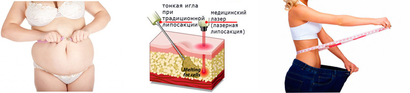 липосакция-живота