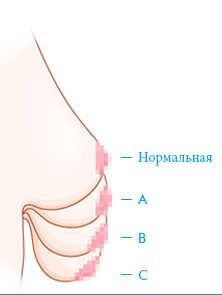 птоз