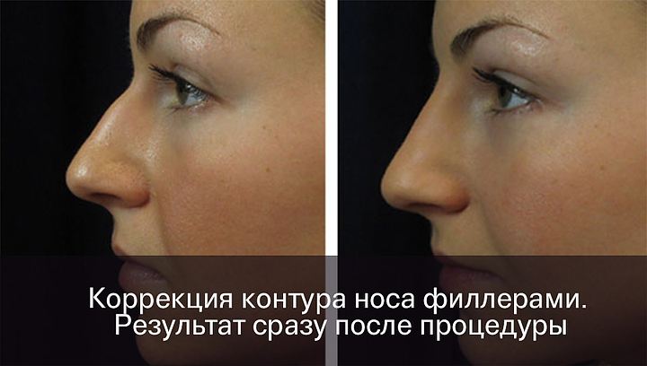 Безоперационная коррекция филлерами