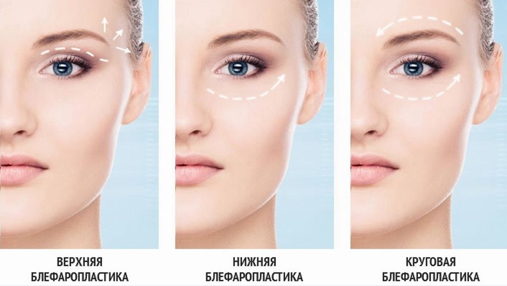 блефаропластика