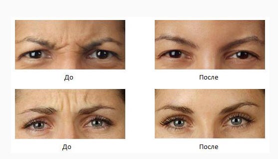 пластика лба