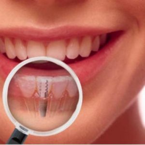 Имплантология