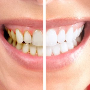 отбеливание зубов