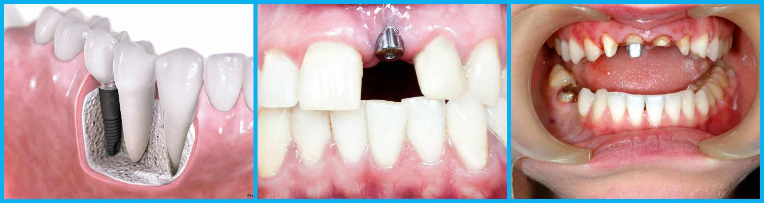 Имплантология в центре стоматологии в Москве